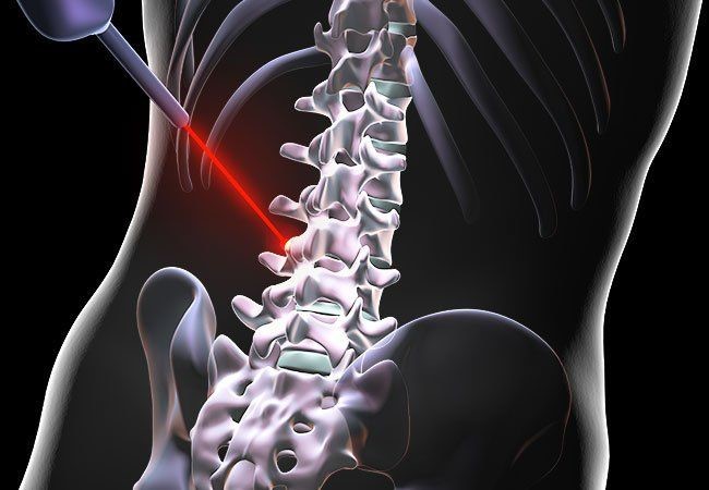 همه چیز درباره عمل لیزر دیسک کمر